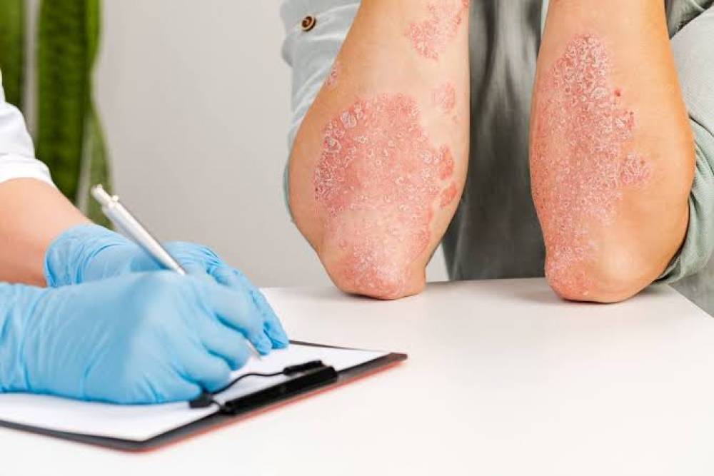 Nueva píldora contra la psoriasis promete cambiar tratamientos tradicionales